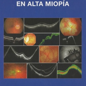 Patologia retiniana en alta miopia.jpg