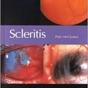 Scleritis.jpg