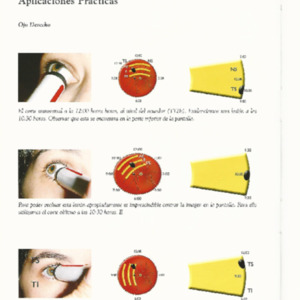 Ecografi ocular Yugar muestra cap.pdf