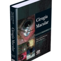 cirugia macular.png