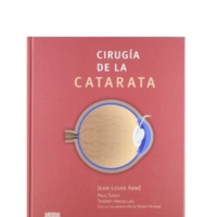 Cirugia de la catarata.jpg