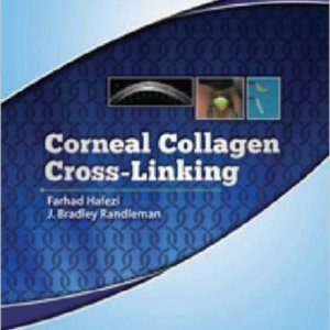 Corneal collagen cross linking.jpg