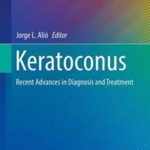 Keratoconus.jpg