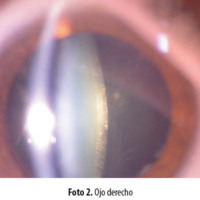 Foto 2. Ojo derecho