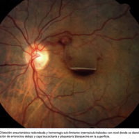 Figura 1. Dilatación aneurismática redondeada y hemorragia sub-limitante interna/sub-hialoidea con nivel donde se identifica sedimentación de eritrocitos debajo y capa leucocitaria y plaquetaria blanquecina en la superficie.