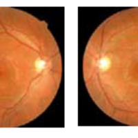 Tomografia de Coherencia Optica Tridimensional en la Retinopatía Solar Crónica