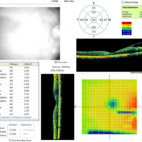 Figura 18. OCT macular OD. Se observa arquitectura macular conservada, sin imágenes de hipo o hiperrefringencias.