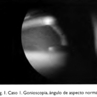 Fig. I. Caso I. Gonioscopia, ángulo de aspecto normal.