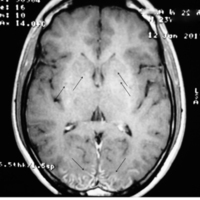 Figura 1. RMN con contraste: lesiones puntiformes en ganglios de la base.
