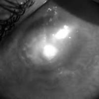 Queratoplastia terapéutica en queratitis por Acantoameba