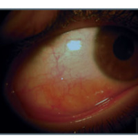 Amiloidosis conjuntival en un niño