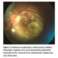 Figura 5. Granuloma en la papila óptica, estrella macular y múltiples hemorragias y exudados en un caso de neurorretinitis posiblemente relacionada con TBC. Cortesía de la Dra. Daniela Rosales, Hospital Santa Lucía, Buenos Aires.