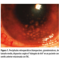 Figura 1. Precipitados retroqueráticos blanquecinos, granulomatosos, de tamaño medio, dispuestos según el “triángulo de Arlt” en un paciente con uveítis anterior relacionada con TBC.