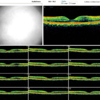 Figura 15. OCT macular OD. Se observa una gran mejoría en la arquitectura macular. Ha desaparecido la hiporrefringencia a nivel subretinal (EM 222 μm).