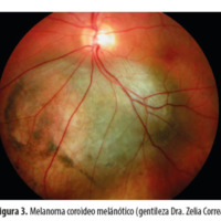 Figura 3. Melanoma coroideo melánótico (gentileza Dra. Zelia Correa).