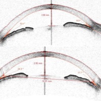 Glaucoma agudo por cierre angular secundario 