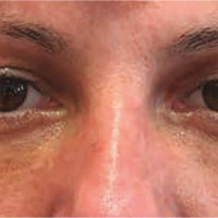 Control postoperatorio a las 5 semanas de reposición grasa y blefaroplastia superior.