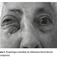 Figura 3. Posquirúrgico inmediato de orbitotomía lateral derecha descompresiva.