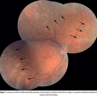 Figura 1. Lesiones de retinitis multifocal profundas ubicadas en polo posterior y periferia media (flechas negras) sin aparente compromiso inflamatorio vascular ni del nervio 