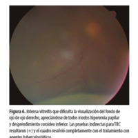 Figura 6. Intensa vitreítis que dificulta la visualización del fondo de ojo de ojo derecho, apreciándose de todos modos hiperemia papilar y desprendimiento coroideo inferior. Las pruebas indirectas para TBC resultaron (+) y el cuadro resolvió completamente con el tratamiento con agentes tuberculostáticos.