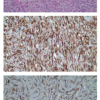 Figura 13. Examen microscópico con H/E, vimentina (a y b); tinción inmunohistoquímica para bcl-2 y CD 34 (c).