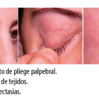 Figura 2. Aumento de pliege palpebral.<br />
Figura 3. Laxitud de tejidos.<br />
Figura 4. Telangiectasias.