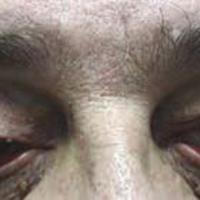 Figura 5. Ptosis de pestañas, ectropión, conjuntivitis papilar crónica, con empeoramiento del lado en que el paciente prefiere dormir (izquierdo).