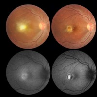 <br />
Figura 5. Caso 3: retinitis macular aislada. Hiperautofluorescencia de menor tamaño que la lesión oftalmoscópica. Patrón de AFF al mes de seguimiento. El tamaño de la cicatriz es similar al de la lesión en el patrón inicial de AFF.<br />
