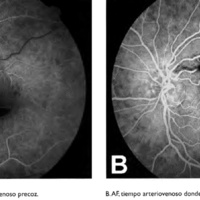 Figura 2. A. Angiografía fluoresceínica, tiempo arteriovenoso precoz. B. AF, tiempo arteriovenoso donde se visualiza el macroaneurisma.