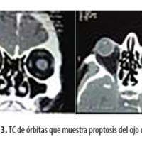 Figura 3. TC de órbitas que muestra proptosis del ojo derecho.
