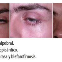 Figura 5. Ptosis palpebral.<br />
Figura 6. Pliegue epicántico.<br />
Figura 7. Atrofia grasa y blefarofimosis.