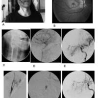 Infarto Retinal Agudo y Neuropatía Optica Isquémica Anterior Asociadas, Debido a Robo Hemodinámico a la Arteria Oftálmica