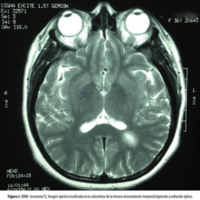 Figura 3. RMN. Secuencia T2. Imagen quística localizada en la subcorteza de la tercera circunvolución temporal izquierda y radiación óptica.