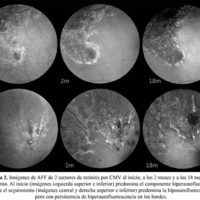 Figura 2. Imágenes de AFF de 2 sectores de retinitis por CMV al inicio, a los 2 meses y a los 18 meses de seguimiento. Al inicio (imágenes izquierda superior e inferior) predomina el componente hiperautofluorescente. Durante el seguimiento (imágenes central y derecha superior e inferior) predomina la hipoautofluorescencia, pero con persistencia de hiperautofluorescencia en los bordes.