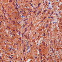 Figura 4. b) Tinción inmunohistoquímica positiva a S-100.