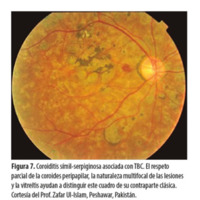 Figura 7. Coroiditis símil-serpiginosa asociada con TBC. El respeto parcial de la coroides peripapilar, la naturaleza multifocal de las lesiones y la vitreítis ayudan a distinguir este cuadro de su contraparte clásica. Cortesía del Prof. Zafar Ul-Islam, Peshawar, Pakistán.
