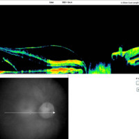 Figura 7. OCT OD se realiza corte en el haz papilomacular. Se observa una depresión a nivel de la papila (foseta óptica) e imágenes de hiporrefringencia en las capas retinal y subretinal que se corresponde con edema macular. Membrana hiperrefringente por encima de la capa de fibras nerviosas que podría corresponderse a la hialoides posterior.