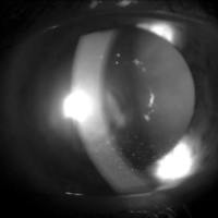 Uveitis Postestreptocóccica