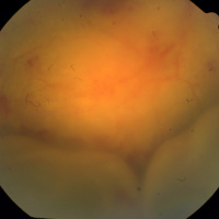 Figura 4. Mujer de 62 años con compromiso bilateral por linfoma vitreorretinal primario. En OD la infiltración comprometió en forma difusa la retina y el espacio subretinal, dando lugar a un desprendimiento seroso de la retina.
