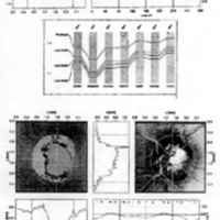 Fig. 9. Caso 3. HRT, aumento de excavación de la papila en ambos ojos.