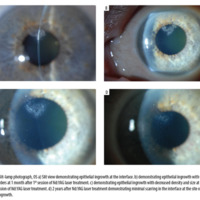 Figure 1. Slit-lamp photograph, OS a) Slit view demonstrating epithelial ingrowth at the interface. b) demonstrating epithelial ingrowth with well defined borders at 1 month after 1st session of Nd:YAG laser treatment. c) demonstrating epithelial ingrowth with decreased density and size at 1 month after 2nd session of Nd:YAG laser treatment. d) 2 years after Nd:YAG laser treatment demonstrating minimal scarring in the interface at the site of previous epithelial ingrowth.