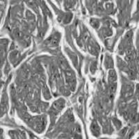 Figura 2. Tinción hematoxilina-eosina del músculo elevador. Se observan fibras musculares rodeadas por material hialino.