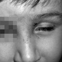 Herpes zoster oftálmico en niño de 3 años sin inmunodepresión no vacunado: revisión bibliográfica 