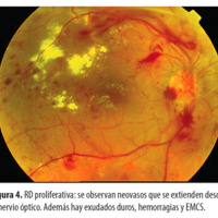 Figura 4. RD proliferativa: se observan neovasos que se extienden desde el nervio óptico. Además hay exudados duros, hemorragias y EMCS.