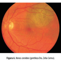 Figura 6. Nevus coroideo (gentileza Dra. Zelia Correa).	