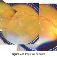 Figura 5. ROP agresiva posterior.