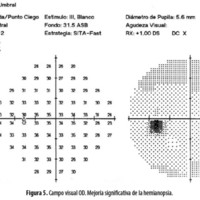 Figura 5. Campo visual OD. Mejoría significativa de la hemianopsia.