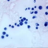 Figura 6. Material de punción vítrea. Técnica: HyE. Se reconocen las células de probable estirpe linfoide con marcada anisocariosis, hipercromatosis y mitosis (células atípicas de aspecto linfoide).