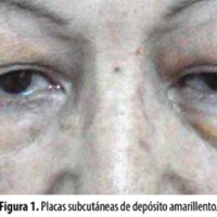 Xantogranuloma orbitario en el síndrome de Mikulicz: a propósito de un caso