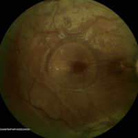 Figura 1. RG color OD. Se observa una sobreelevación redondeada circunscripta a nivel macular que se corresponde con un edema macular.